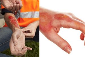 Steps for Claiming Compensation for Burn Accidents
